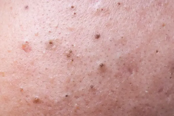 جوش سر سیاه